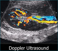 doppler ultrasound