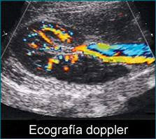 doppler ultrasound