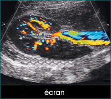 erectyle dysfuction