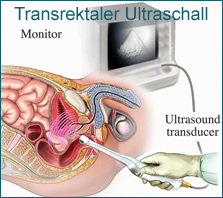 erectyle dysfuction