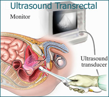 ultrasound Transrectal